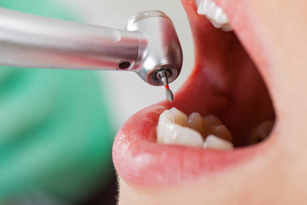 Best Emergency Root Canal Treatment in North Puyallup, WA